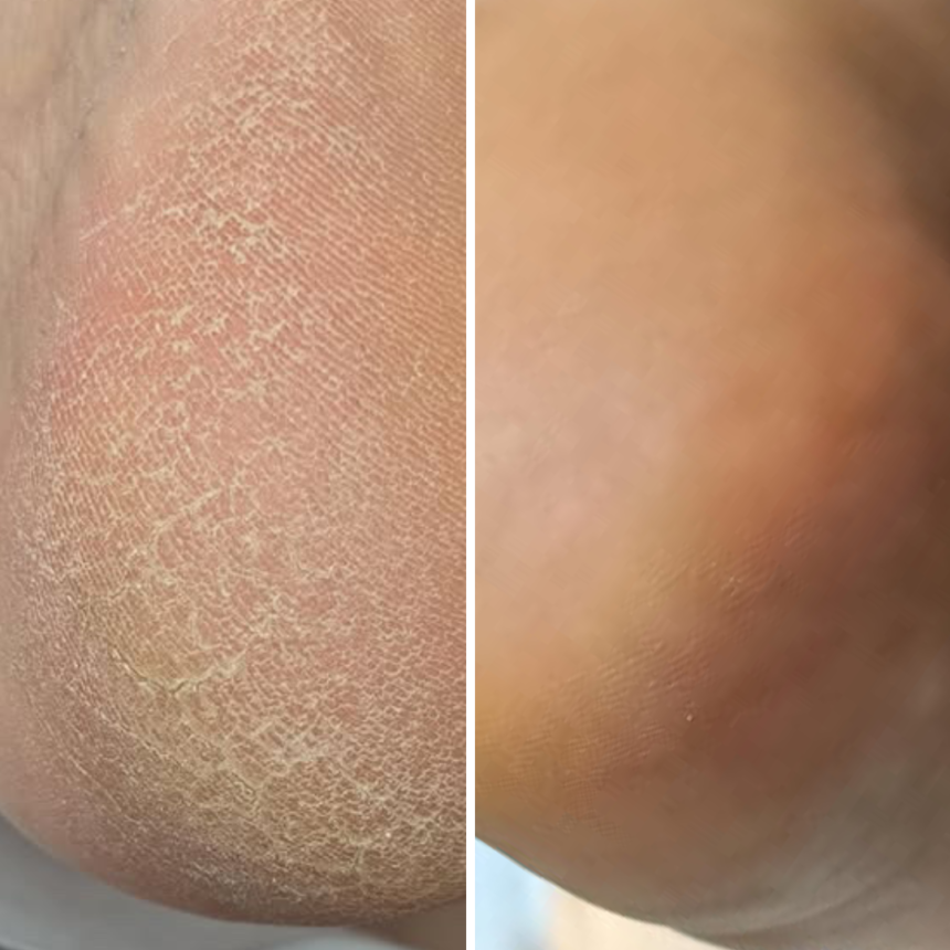 Regenerix Cream 50ml– регенериращ крем против напуквания с облепиха и лимонена трева